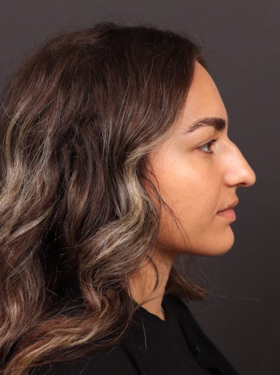 Primary Rhinoplasty Before & After Gallery - Patient 409431 - Image 1