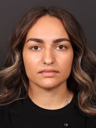 Primary Rhinoplasty Before & After Gallery - Patient 409431 - Image 1