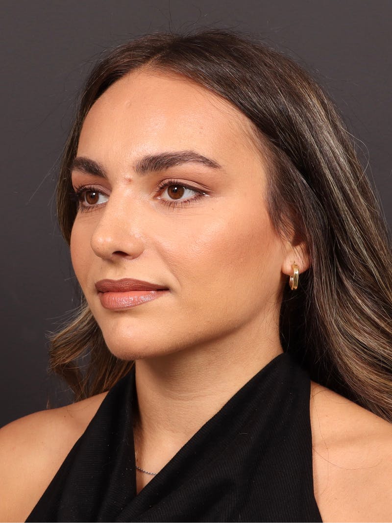 Primary Rhinoplasty Before & After Gallery - Patient 409431 - Image 8