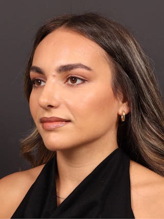 Primary Rhinoplasty Before & After Gallery - Patient 409431 - Image 8