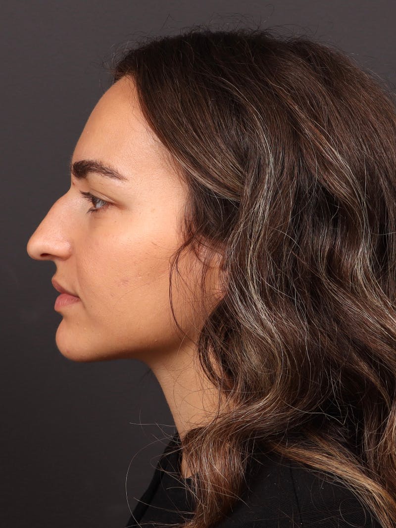 Primary Rhinoplasty Before & After Gallery - Patient 409431 - Image 9