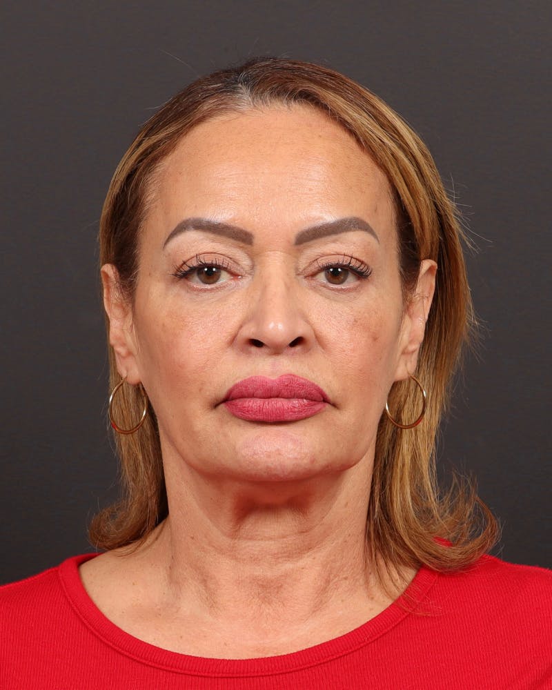 Neck Lift Before & After Gallery - Patient 152219 - Image 1
