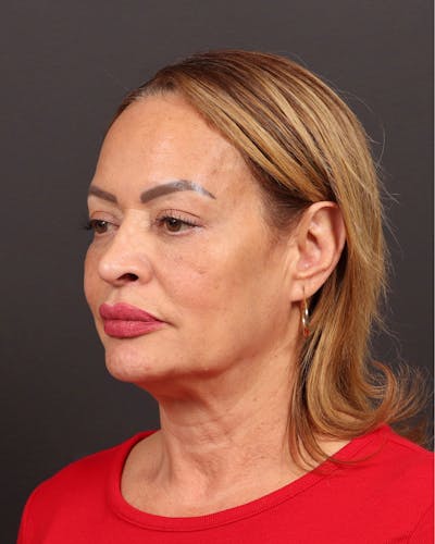 Neck Lift Before & After Gallery - Patient 152219 - Image 1