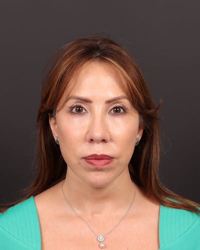 Facelift Before & After Gallery - Patient 108240 - Image 2
