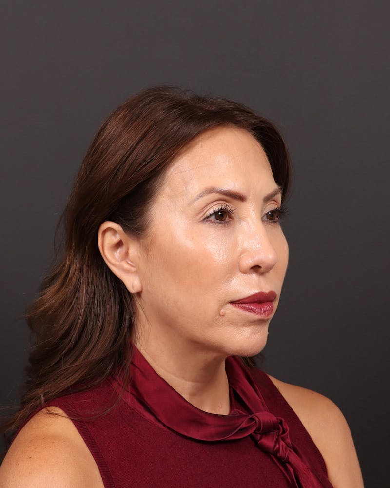 Facelift Before & After Gallery - Patient 108240 - Image 7