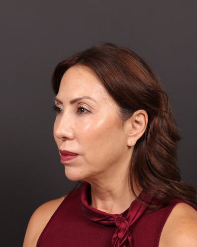 Neck Lift Before & After Gallery - Patient 388534 - Image 1