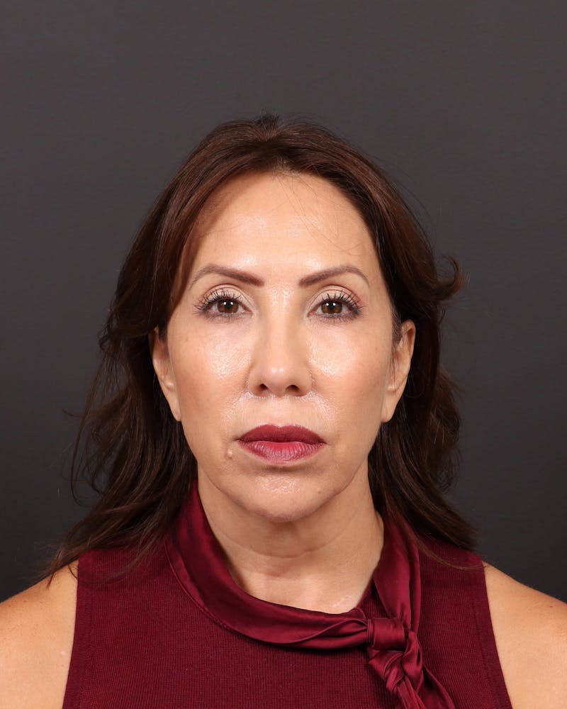 Facelift Before & After Gallery - Patient 108240 - Image 1