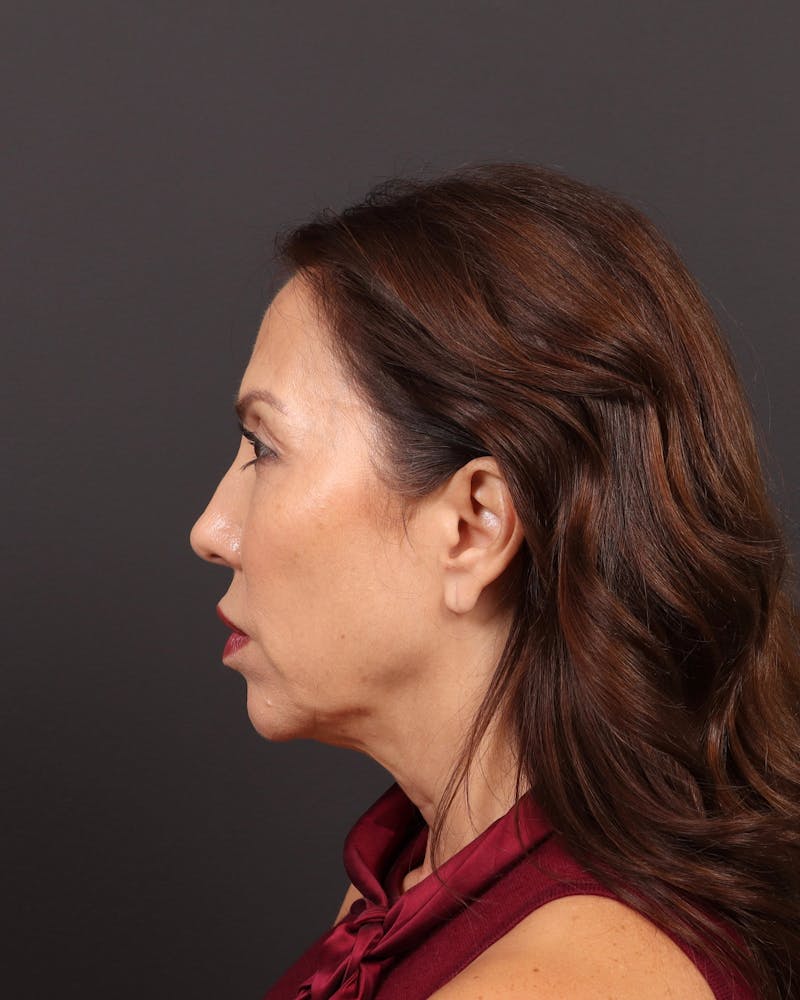 Facelift Before & After Gallery - Patient 108240 - Image 5