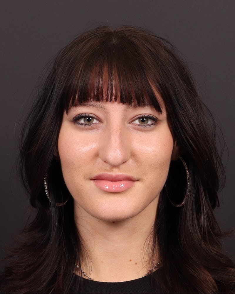 Primary Rhinoplasty Before & After Gallery - Patient 223757 - Image 3