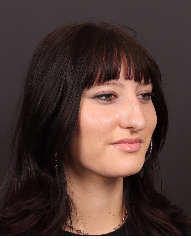 Primary Rhinoplasty Before & After Gallery - Patient 223757 - Image 5