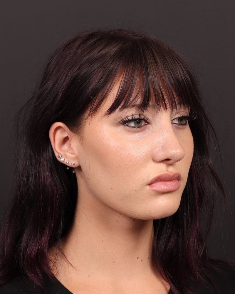 Primary Rhinoplasty Before & After Gallery - Patient 223757 - Image 6