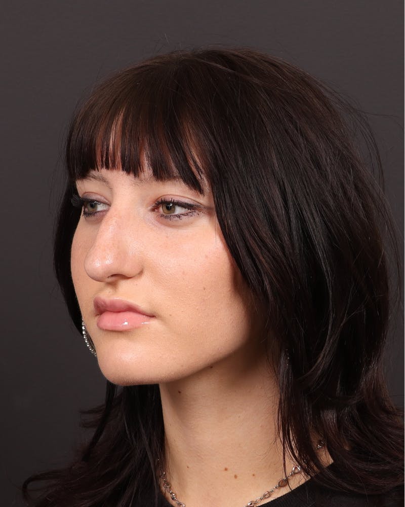 Primary Rhinoplasty Before & After Gallery - Patient 223757 - Image 9