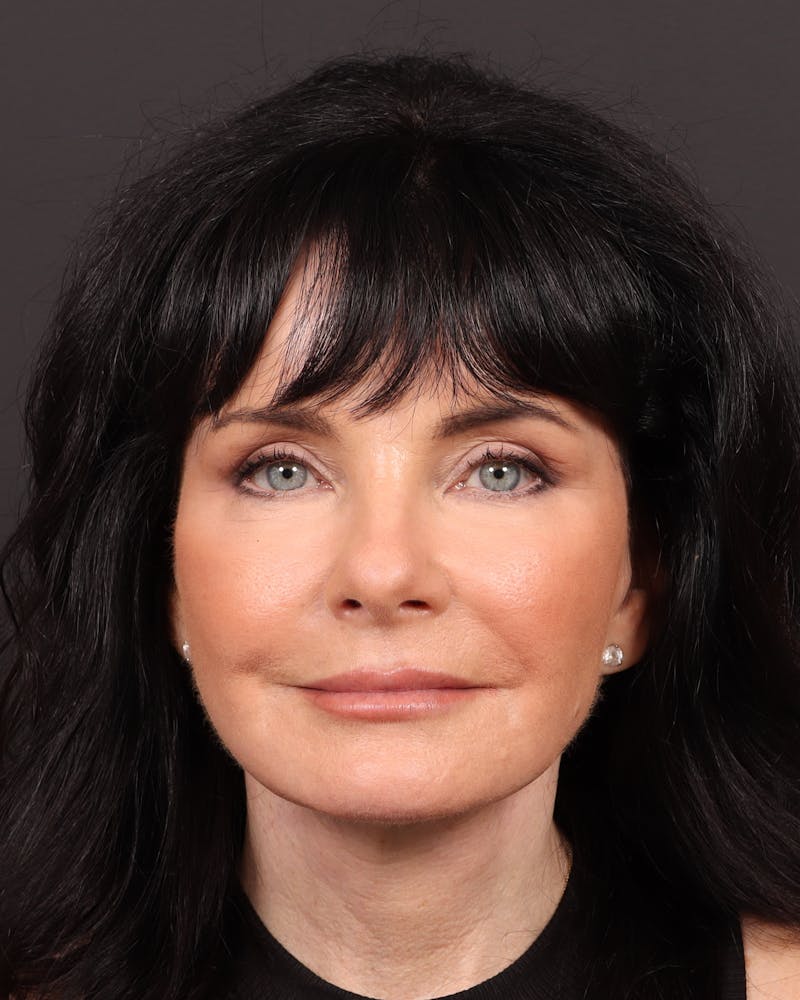 Facial Fat Grafting Before & After Gallery - Patient 551851 - Image 2