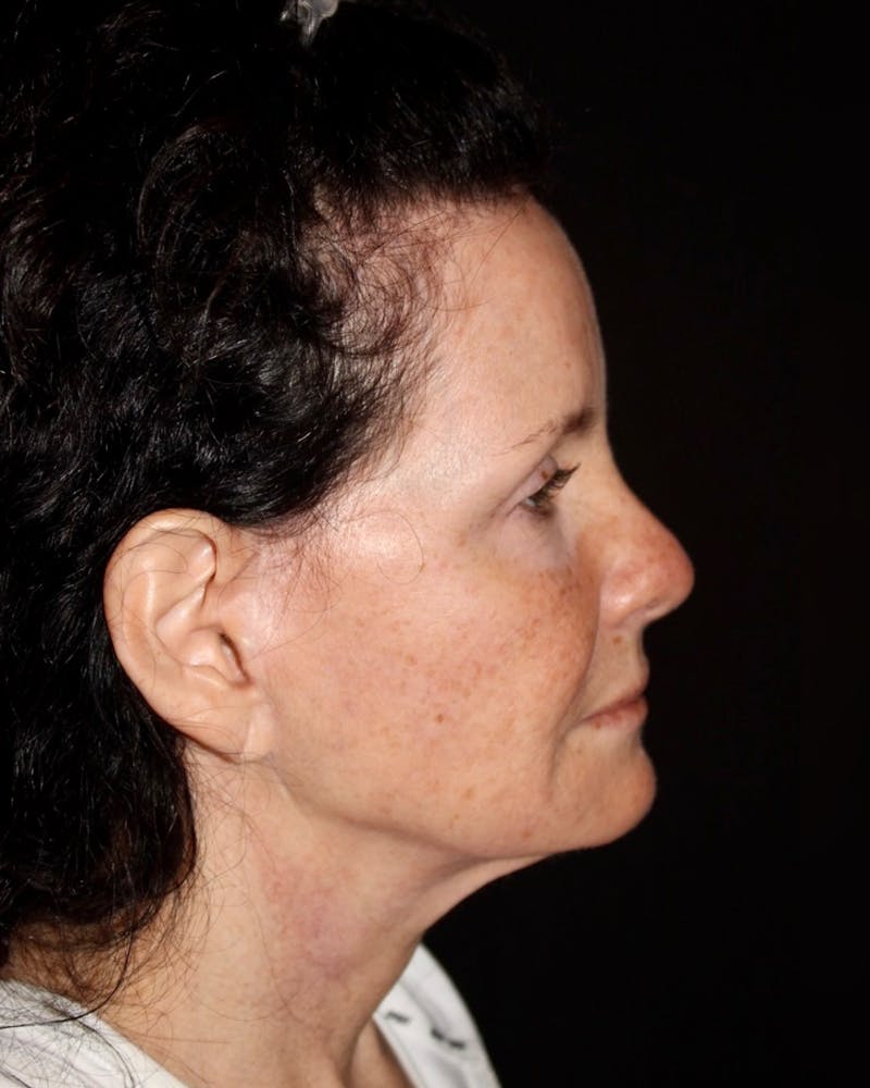 Facial Fat Grafting Before & After Gallery - Patient 551851 - Image 5
