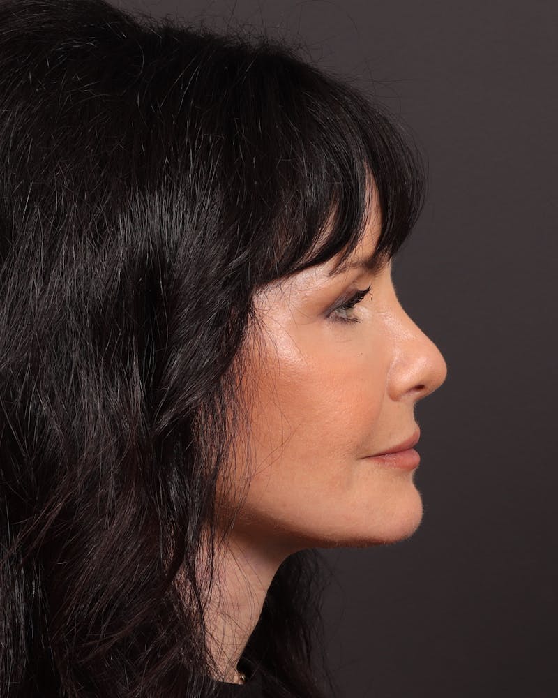 Facial Fat Grafting Before & After Gallery - Patient 551851 - Image 6