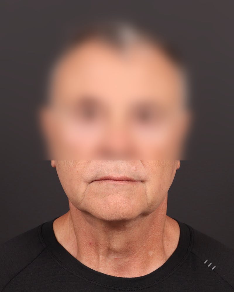 Facelift Before & After Gallery - Patient 343880 - Image 1
