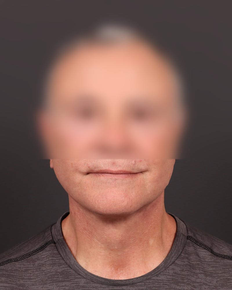Facelift Before & After Gallery - Patient 343880 - Image 2