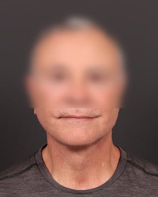 Male Face & Neck Before & After Gallery - Patient 250286 - Image 2