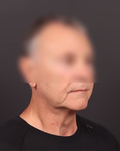 Neck Lift Before & After Gallery - Patient 425627 - Image 1