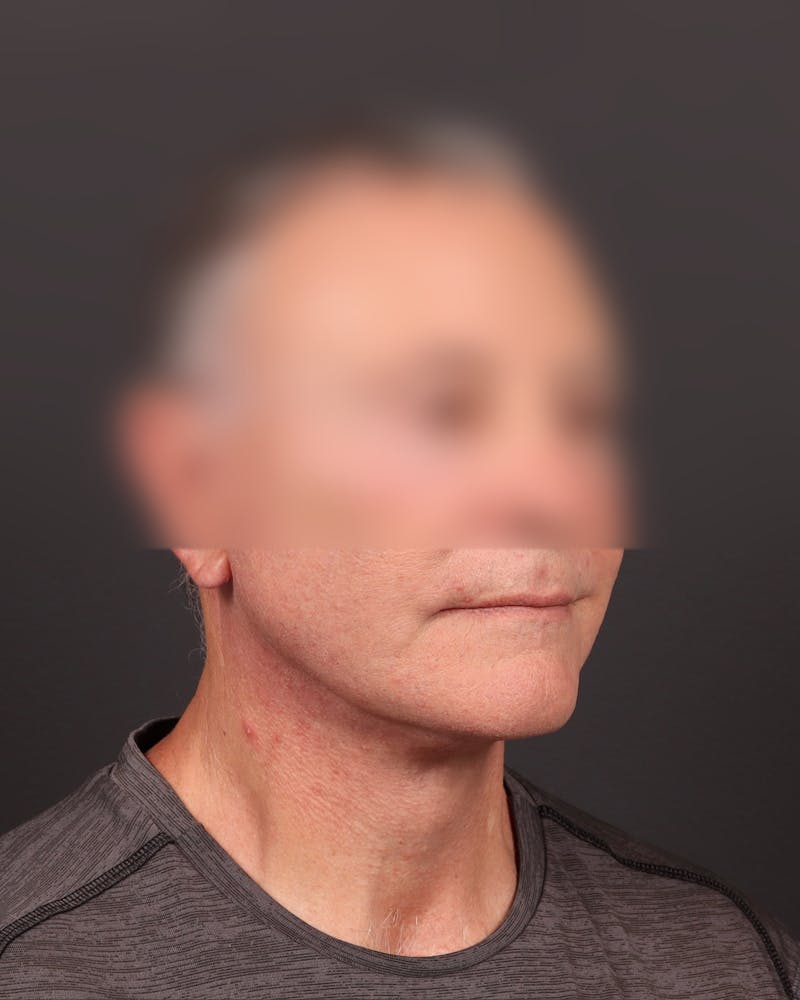 Facelift Before & After Gallery - Patient 343880 - Image 4