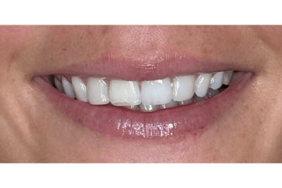 BOTOX Before & After Gallery - Patient 300275 - Image 2