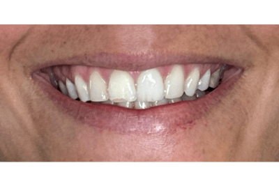 BOTOX Before & After Gallery - Patient 300275 - Image 1