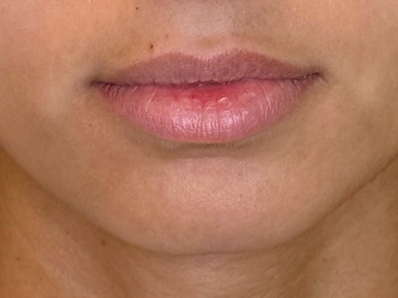 Facial Filler Before & After Gallery - Patient 409028 - Image 3