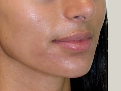 Facial Filler Before & After Gallery - Patient 409028 - Image 2