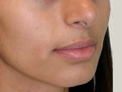 Facial Filler Before & After Gallery - Patient 409028 - Image 1