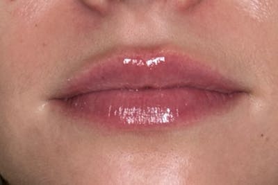 Lip Filler Before & After Gallery - Patient 485745 - Image 2