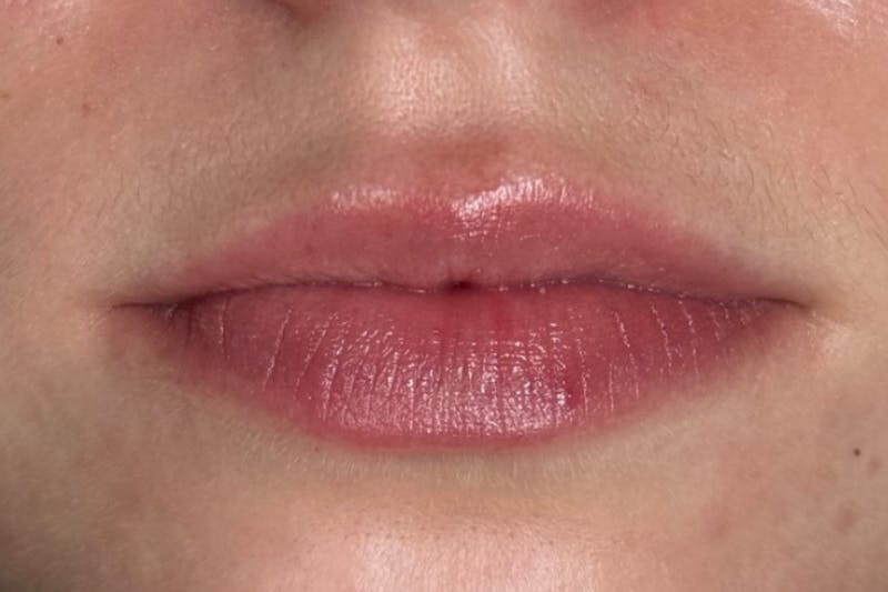Lip Filler Before & After Gallery - Patient 485745 - Image 1