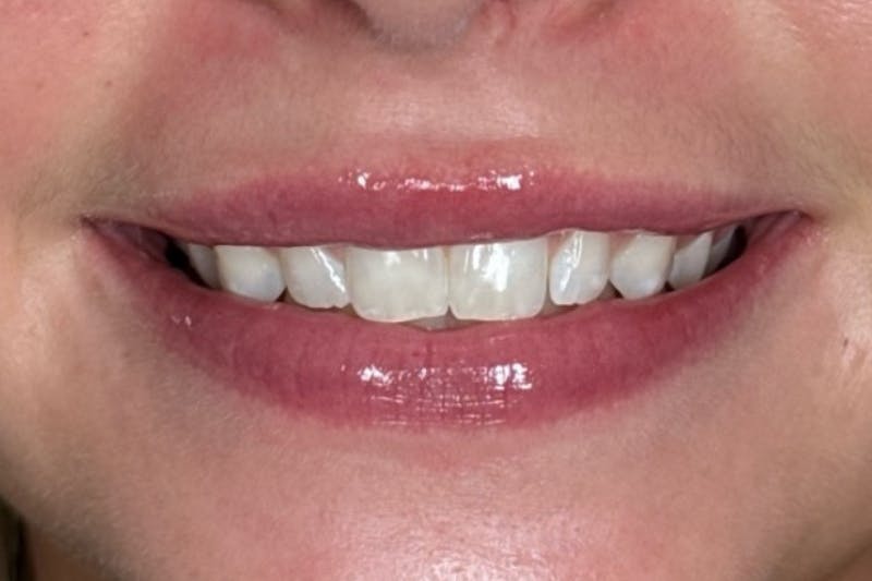 Lip Filler Before & After Gallery - Patient 485745 - Image 4
