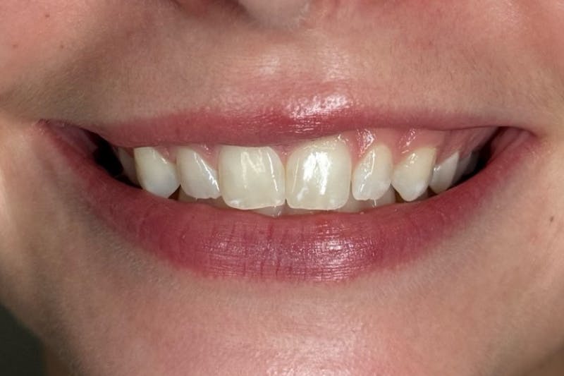 Lip Filler Before & After Gallery - Patient 485745 - Image 3