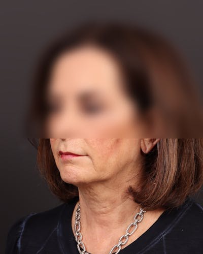 Neck Lift Before & After Gallery - Patient 253960 - Image 1