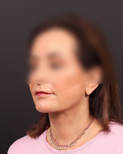 Neck Lift Before & After Gallery - Patient 253960 - Image 2