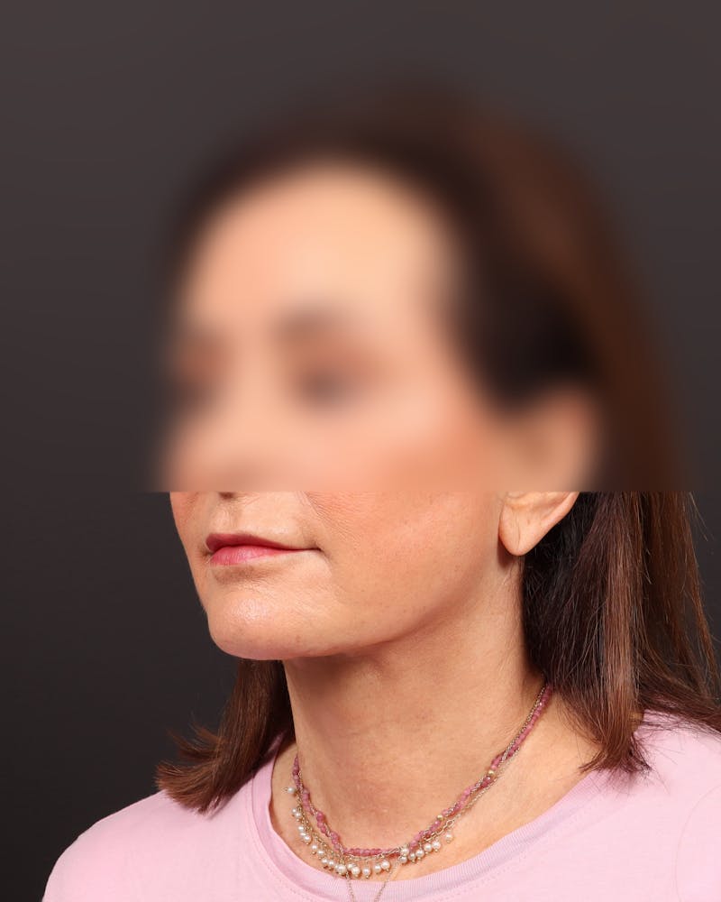Neck Lift Before & After Gallery - Patient 253960 - Image 2