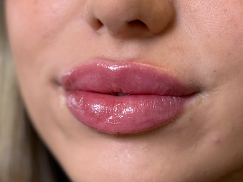 Lip Filler Before & After Gallery - Patient 564315 - Image 2