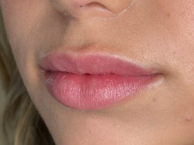 Lip Filler Before & After Gallery - Patient 564315 - Image 1