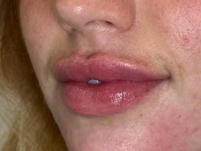 Lip Filler Before & After Gallery - Patient 422595 - Image 2