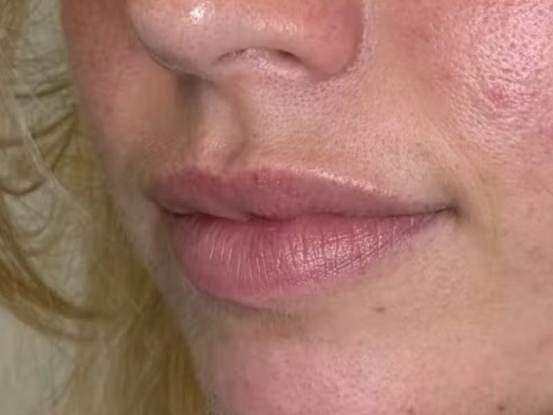 Lip Filler Before & After Gallery - Patient 422595 - Image 1