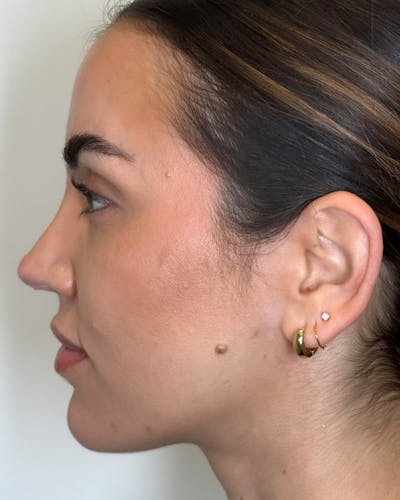 Facial Filler Before & After Gallery - Patient 195585 - Image 2