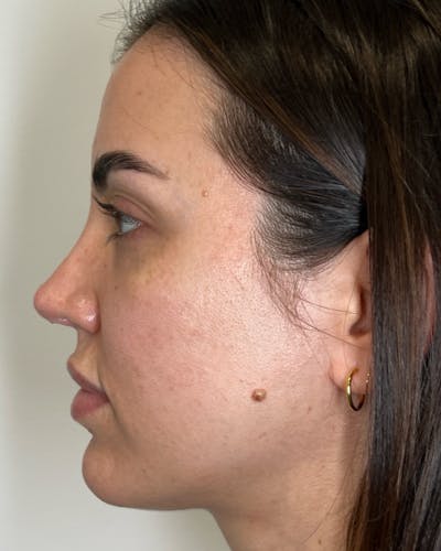 Facial Filler Before & After Gallery - Patient 195585 - Image 1