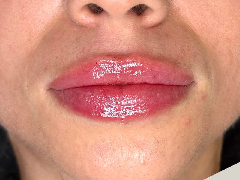 Lip Filler Before & After Gallery - Patient 177056 - Image 2