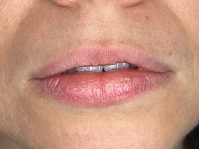 Lip Filler Before & After Gallery - Patient 177056 - Image 1
