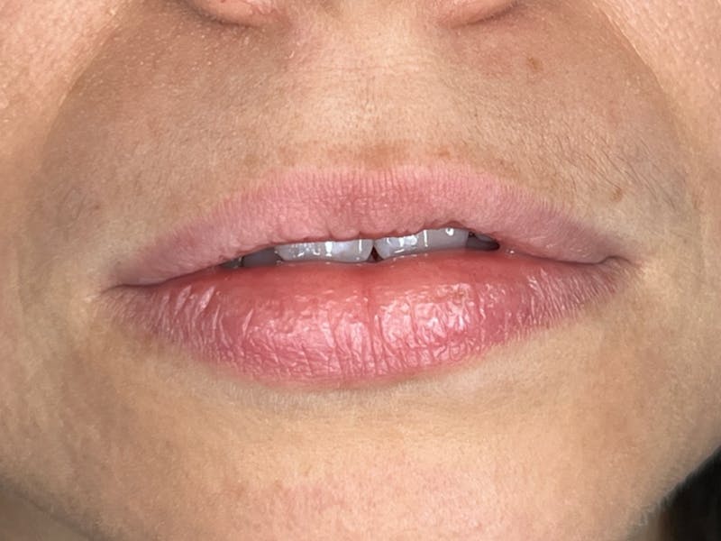 Lip Filler Before & After Gallery - Patient 177056 - Image 1