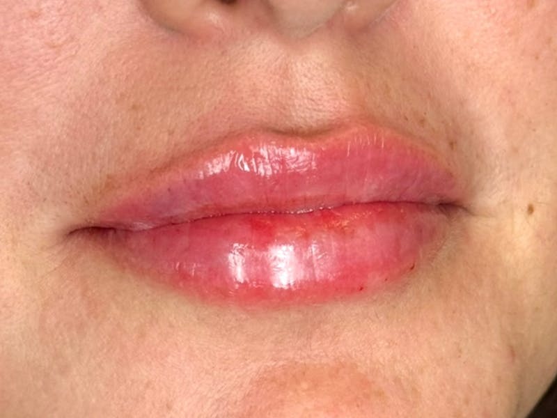 Lip Filler Before & After Gallery - Patient 709869 - Image 2