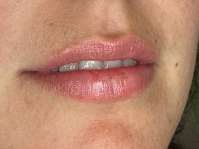 Lip Filler Before & After Gallery - Patient 709869 - Image 1