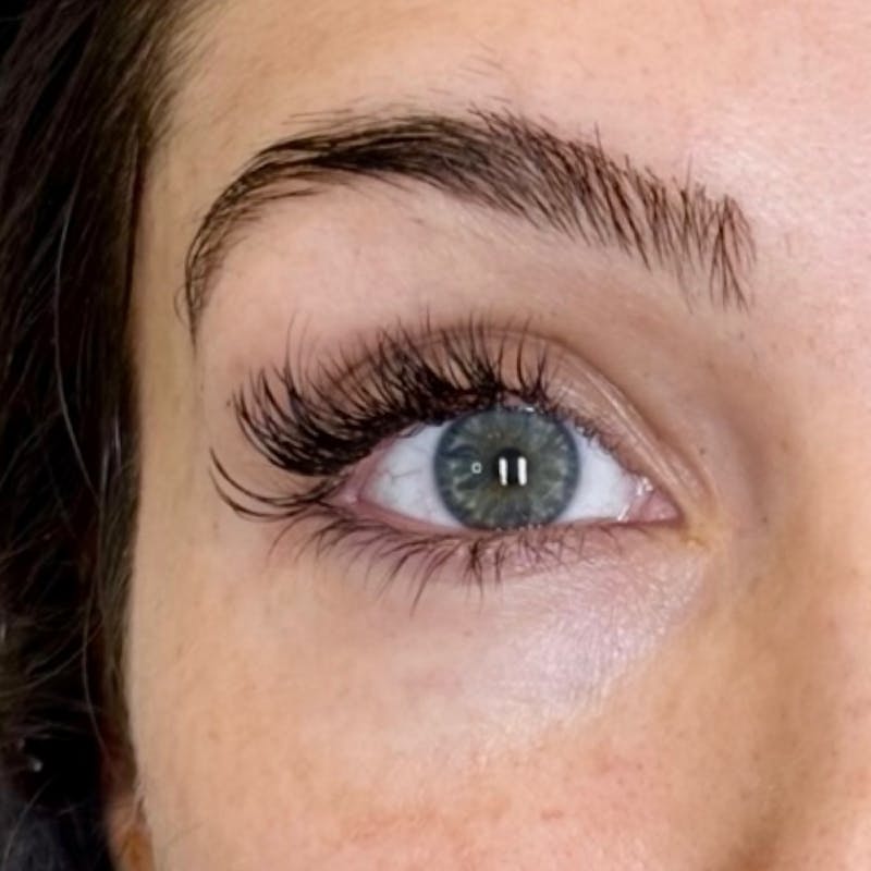 Moxi Laser Before & After Gallery - Patient 348619 - Image 2