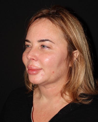 Neck Lift Before & After Gallery - Patient 323043 - Image 1