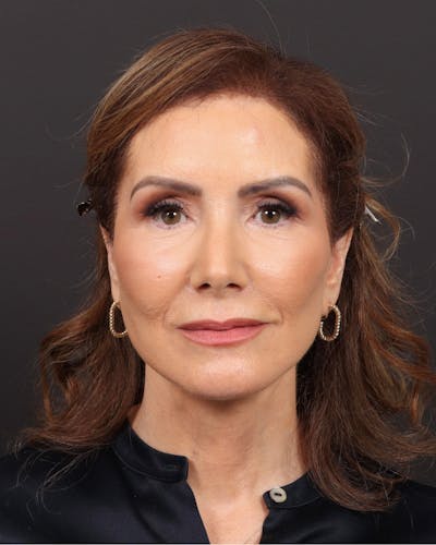 Facelift Before & After Gallery - Patient 262195 - Image 2